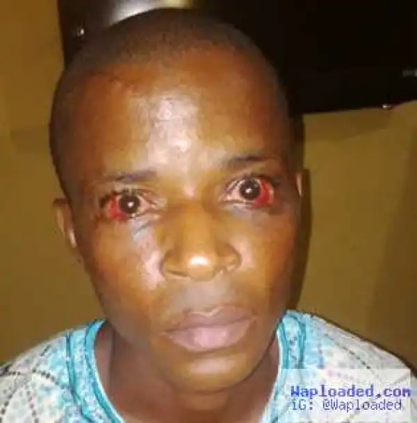 Photo: Man’s eyes badly affected after police brutalized him in Akwa Ibom